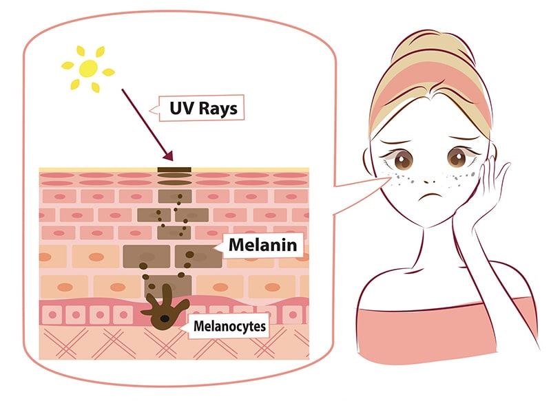 Những ảnh hưởng tiêu cực của melanin với làn da